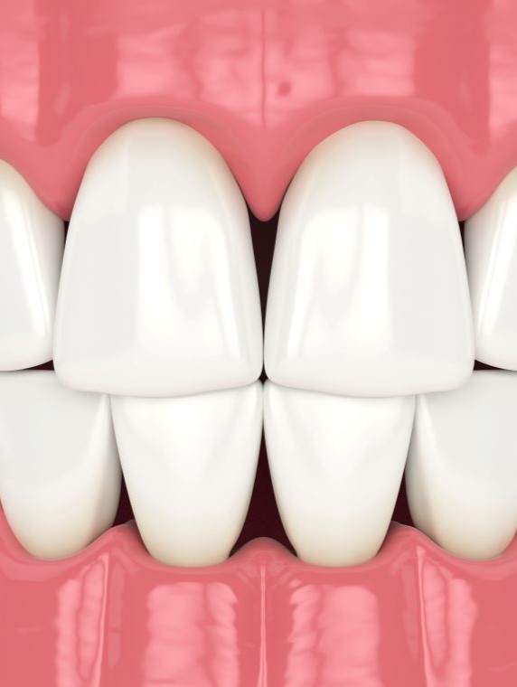 Illustrated smile with small black triangle gaps between the teeth