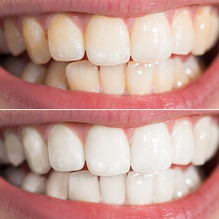 Factors that affect the cost of teeth whitening include the type of stains present on your teeth